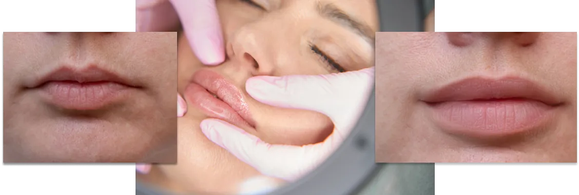 Dermal fillers treatment in Greenville Med Spa, South Carolina