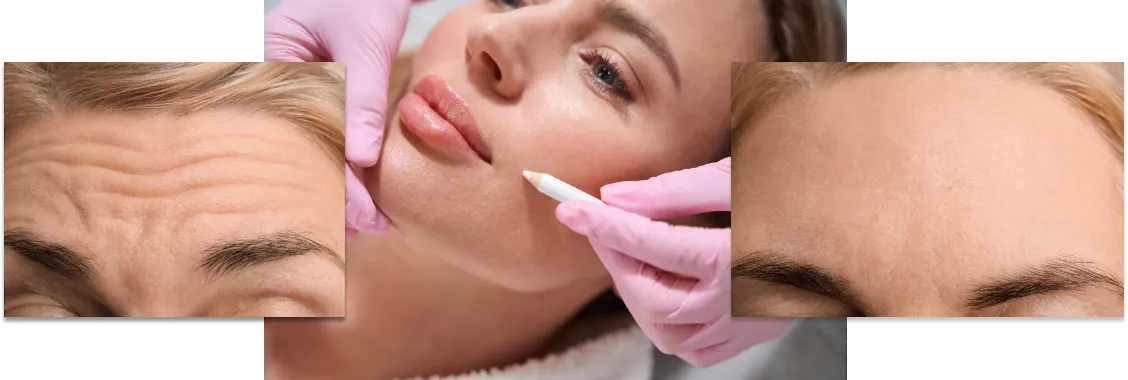 botox treatment in Greenville Med Spa, South Carolina