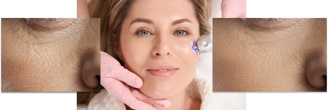 microneedling treatment in Greenville Med Spa, South Carolina