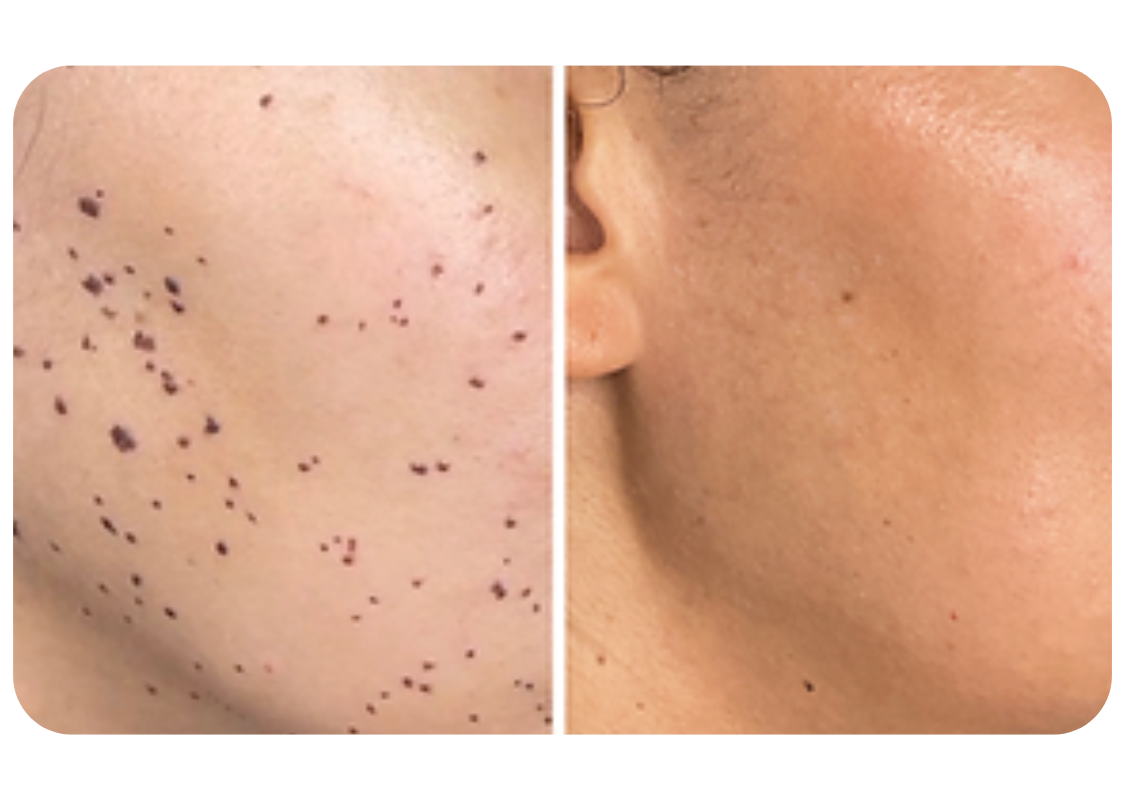 Skin Tag, Mole & DPN Removal