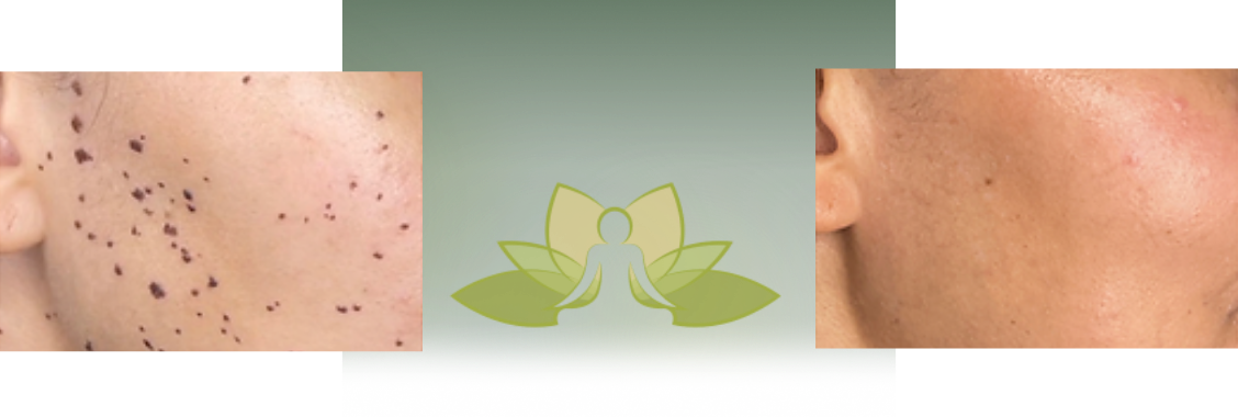 Skin Tag, Mole & DPN Removal in Greenville South Carolina